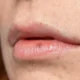 Penyebab Jerawat di Area Bibir Mulut