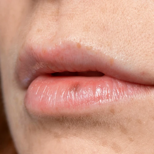 Penyebab Jerawat di Area Bibir Mulut
